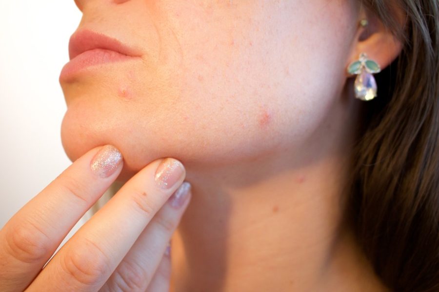 causes-and-symptoms-of-acne-acne