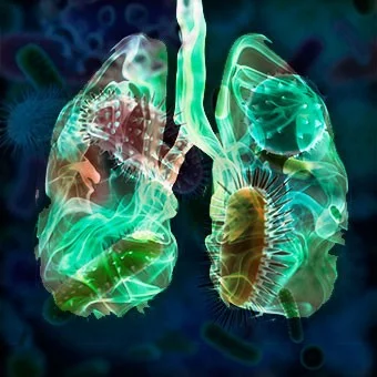 pneumonia s5 causes