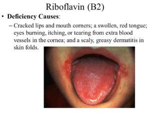 RiboflavinB2DeficiencyCauses