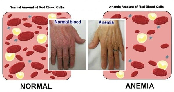 anemia and ice cravings