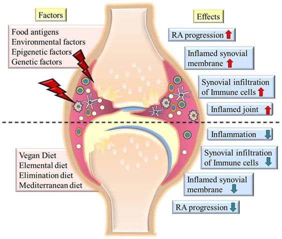 rheumathoid arthritis