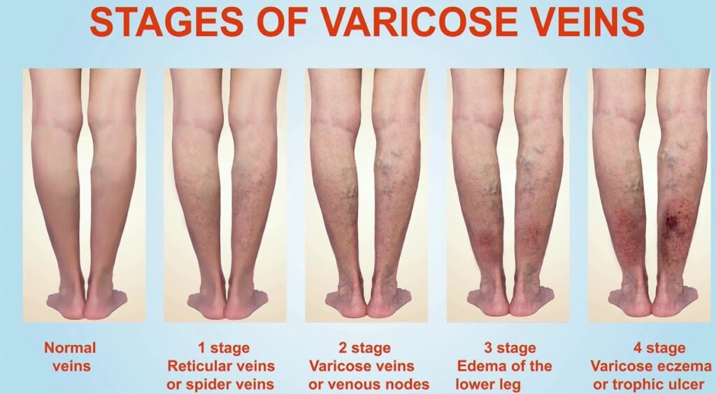 stage varicosevein 1