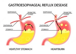 GERD SYMPTOMS