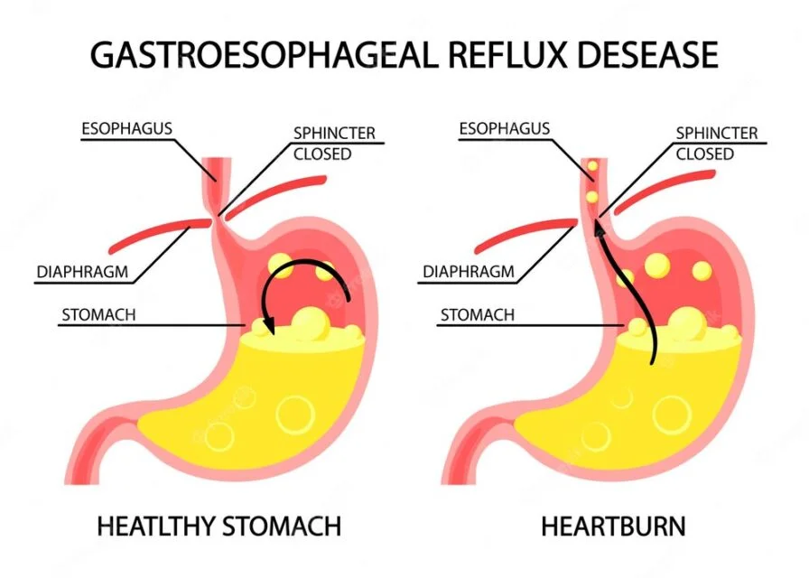 GERD SYMPTOMS
