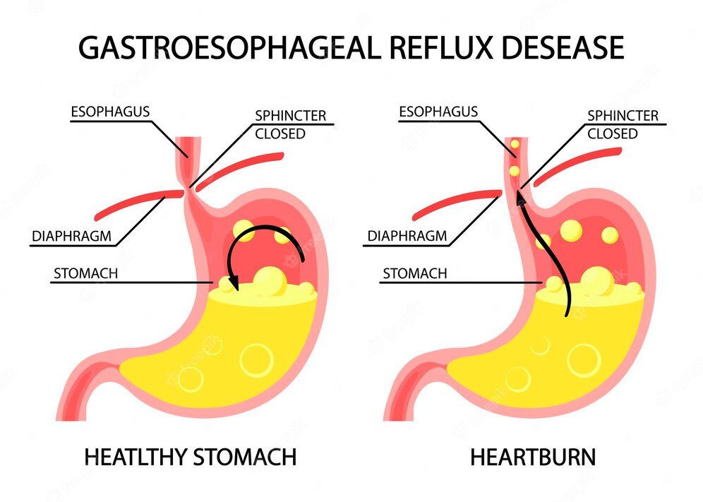 GERD Diet Foods That Help With Acid Reflux Heartburn Weight Loss 