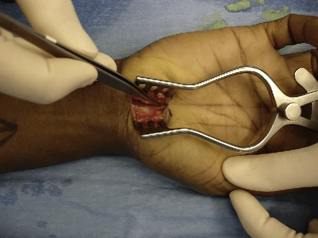 carpal tunnel symptoms surgery